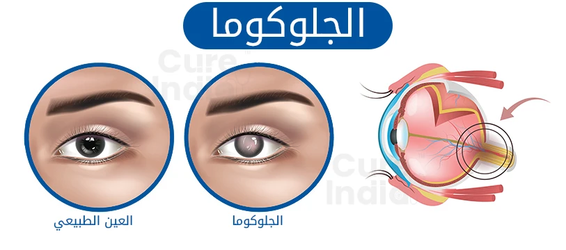 ما هو الجلوكوما